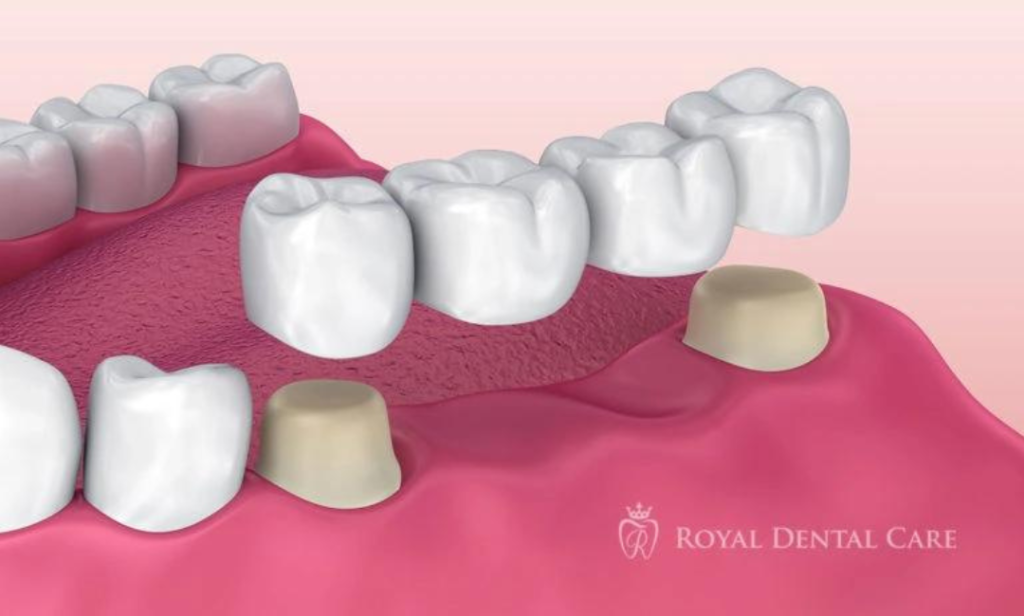 Dental Crowns & Bridges