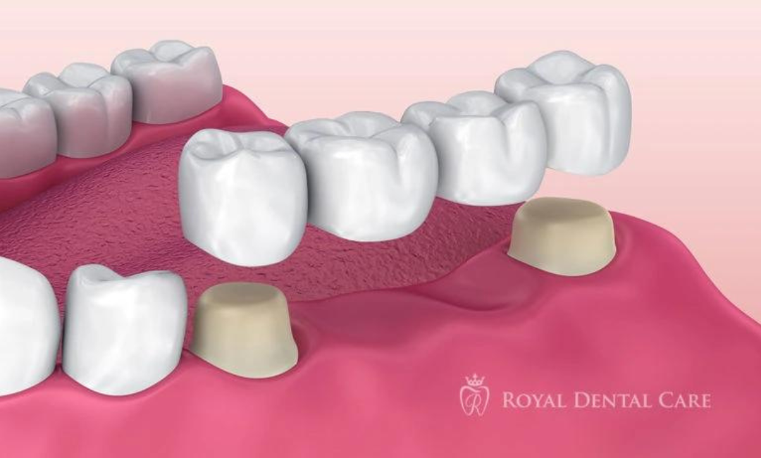 Choosing the Right Crowns Specialist in Sydney: A Comprehensive Guide