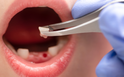 How Professional Tooth Extraction in Frankston Can Protect Your Oral Health