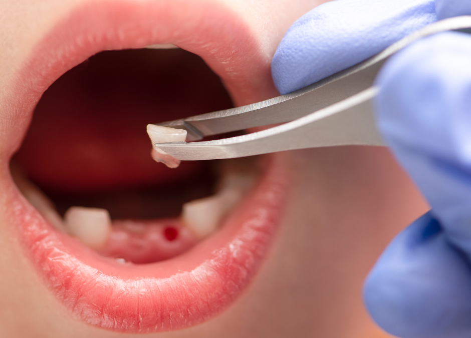 tooth extraction frankston