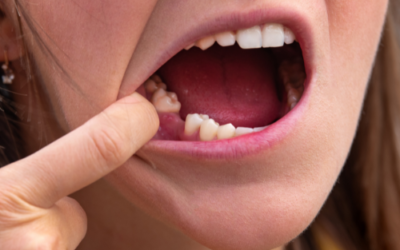 The Cost of Waiting Why Delayed Tooth Replacement Can Increase Future Treatment Needs
