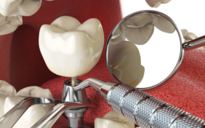 Why Dental Implant Success Begins With Accurate Diagnosis Instead of Surgery
